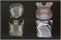 歯科用ctの導入